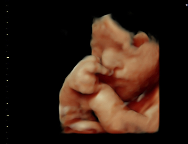 3D ultrasound image at 31 weeks